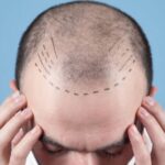 Hair Transplant Clinics in Ravet | Natural, Trusted Results