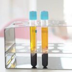 Prp Microneedling London Uk | Thecheclinic.co.uk