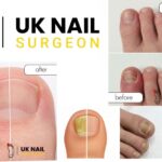 Nail Surgery Birmingham | Fast, Safe Toenail Treatment
