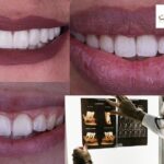 ابتسامة هوليوود: جاذبية ساحرة وتنسيق مثالي للأسنان