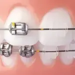 Conroe Dental Implants – Restore Your Smile with Family Smiles of Conroe