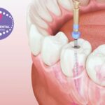 Prótesis Dental Gines: solució natural i còmoda a Clinicadentalcristinamora