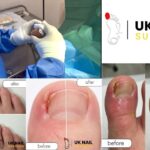 Fungal Nails Treatment: Quick Relief & Expert Care in the UK
