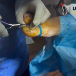 Caring for Kids with Ingrown Toenails: Gentle Solutions and Tips