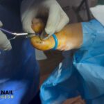 Fungal Nails Removal: Safe Toe Treatment at UK Nail Surgeon